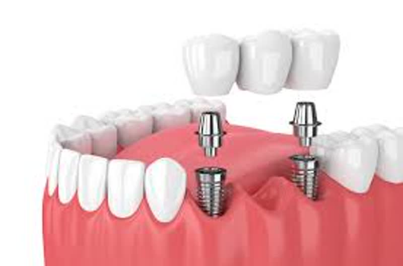 The image displays a close-up view of a set of teeth with dental implants, showcasing the artificial roots attached to the upper and lower dentures.