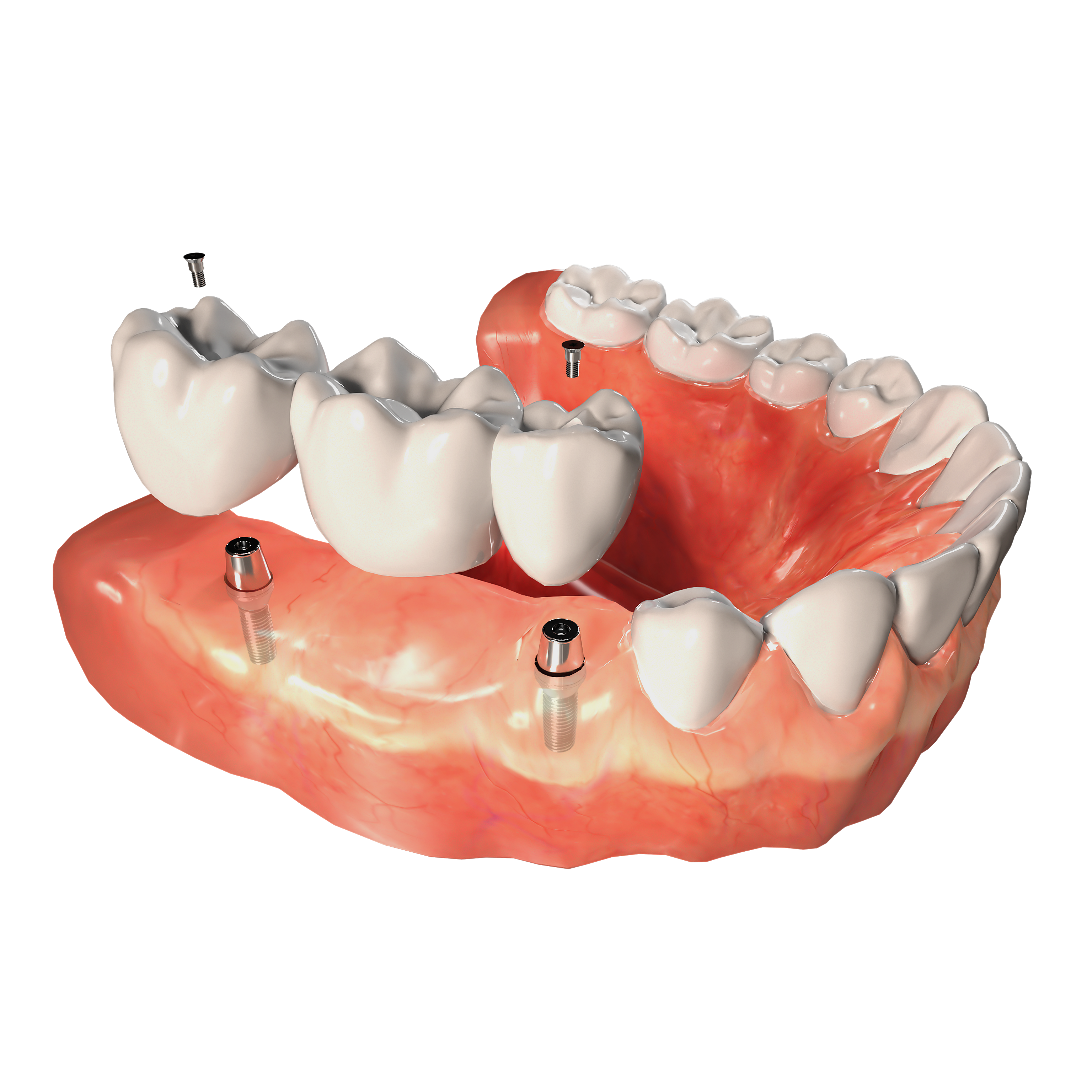 The image shows a 3D model of an upper dental arch with teeth, gums, and implant screws visible against a black background.