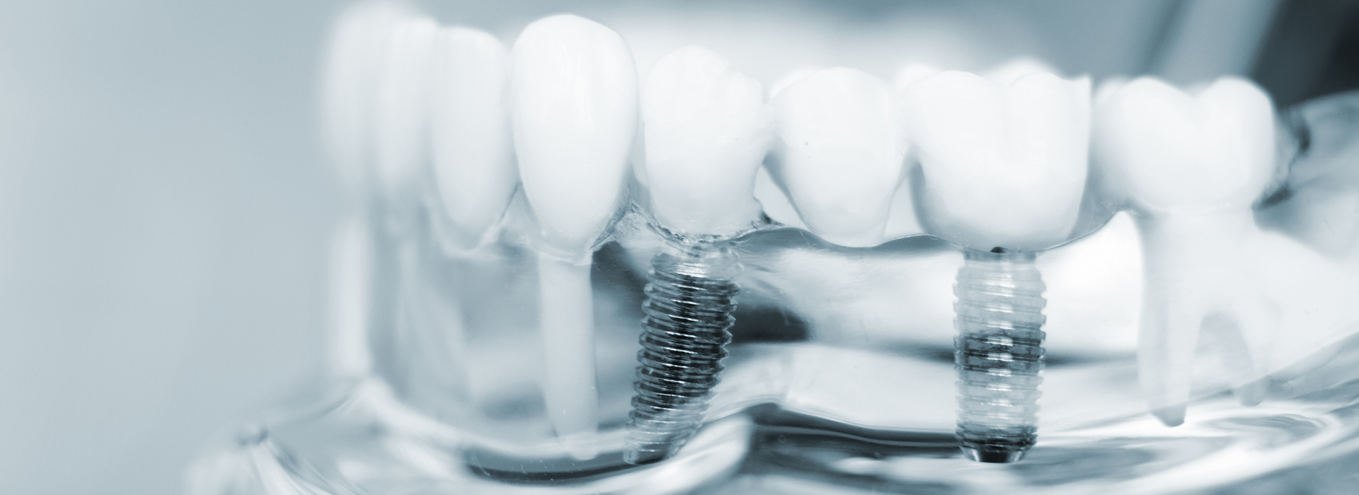 The image displays a close-up view of multiple dental implants with visible screws, placed against a blurred background which suggests a clinical setting.