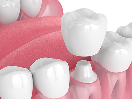 The image displays a collection of artificial teeth with varying shades of pink and white hues against a plain background.