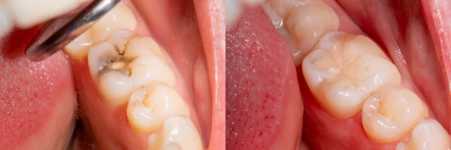 The image shows a close-up view of a dental implant with a screw visible, set against the backdrop of an open mouth with teeth and gums.