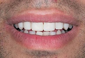 The image shows a close-up view of a person s smiling face with teeth, set against a neutral background.