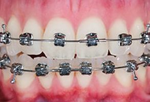 The image displays a close-up view of a person s teeth with braces, showcasing a dental orthodontic treatment.