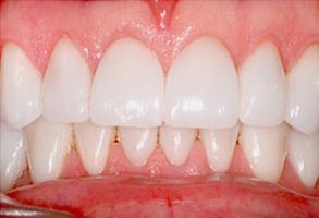 The image shows a pair of teeth with a focus on their whiteness and alignment, likely for dental care or cosmetic dentistry purposes.