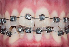 The image shows a close-up view of a person s teeth with braces, featuring a combination of clear and black brackets.
